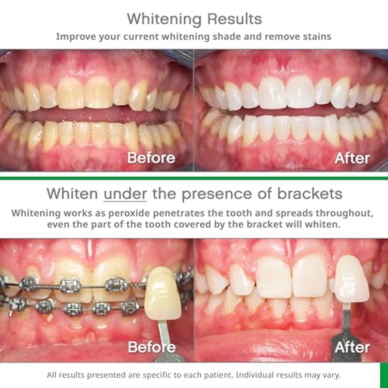 Opalescence Whitening Bundle - Opalescence Go 10% Hydrogen Peroxide Prefilled Whitening Trays and Whitening Toothpaste - Mint Flavor 5194-5166