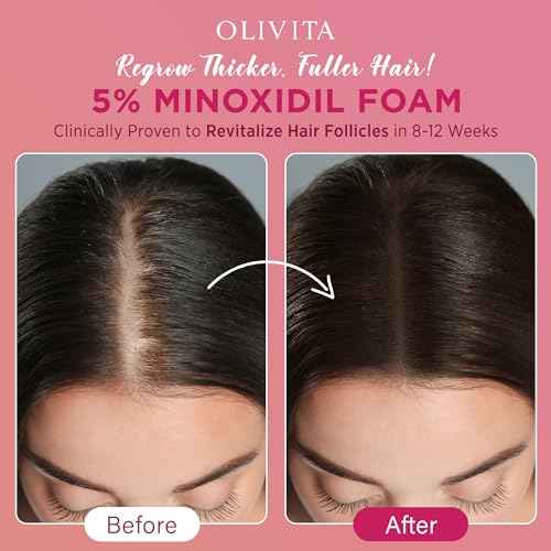 5% Minoxidil Foam for Women Hair Growth: Extra Strength Hair Regrowth Treatment ? Revitalize Hair Follicles & Regrow Thicker, Fuller Hair ? Hair Loss Solution - 2x60ML