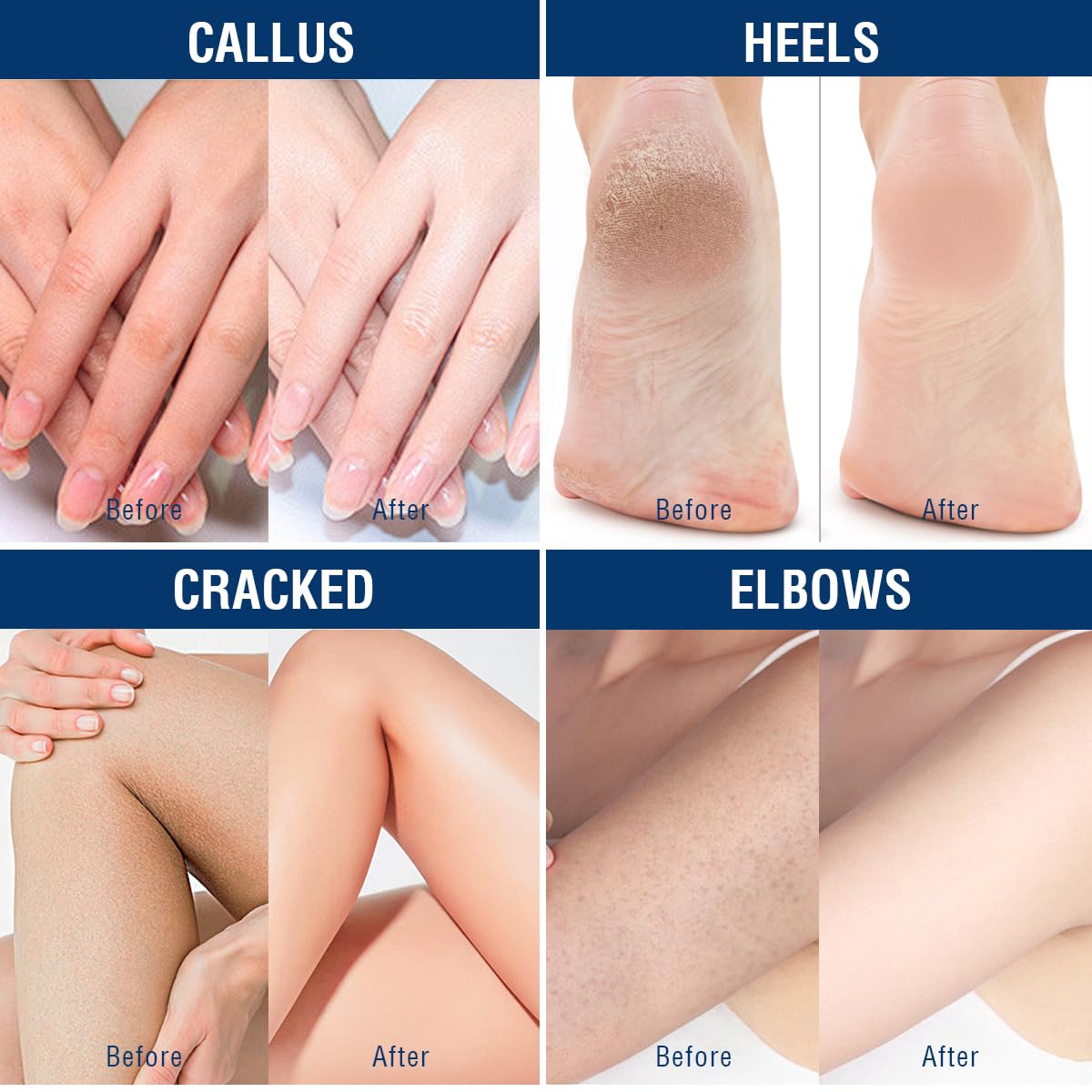 OUKEYA Urea Cream 40% with 2% Salicylic Acid Intensive Foot, Hand & Body Cream for Very Dry, Cracked, Rough Skin on Heels, Knees & Elbows (12.35 Ounce)