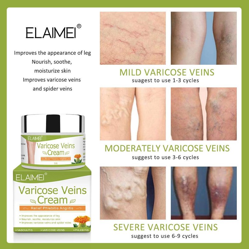 Varicose Vein Cream for Legs - Boost Blood Circulation & Reduce Spider Veins | 3-Pack