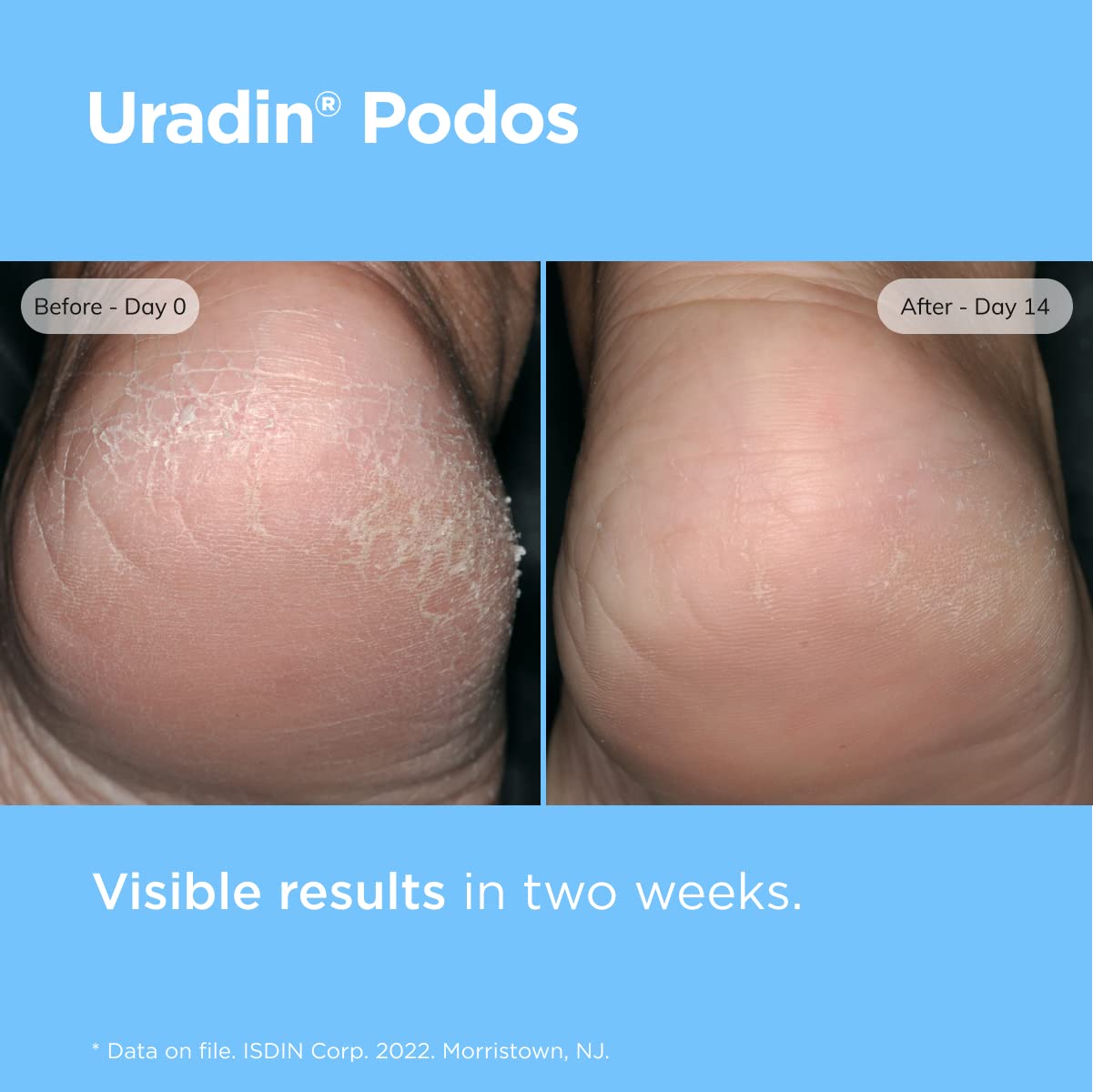 ISDIN Foot Care Cream - Uradin Podos Gel Oil for Dry Cracked Feet | 10% Urea, Fast Absorbing, 2.5 Fl Oz