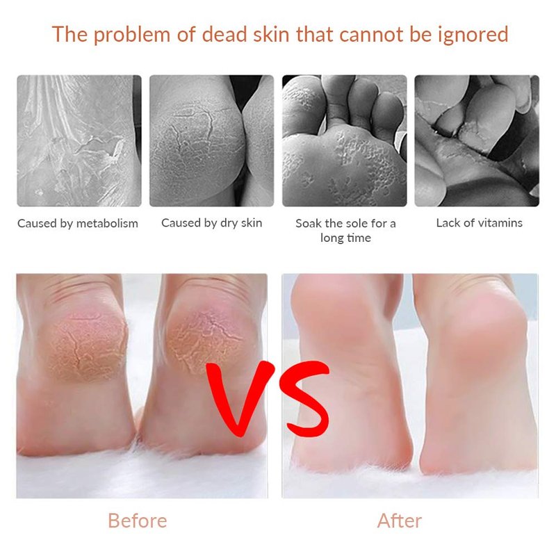 Codream Pedicure Callus Shaver Foot File Care Hard Skin Remover Callus Shaver Sets with Case, Foot File Heads & 10 Replacement Blade