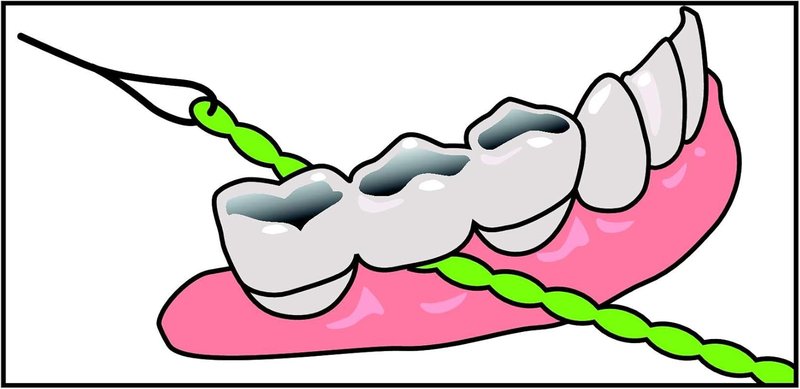 IDontix X-Floss Brace - Durable Green Support for Enhanced Performance