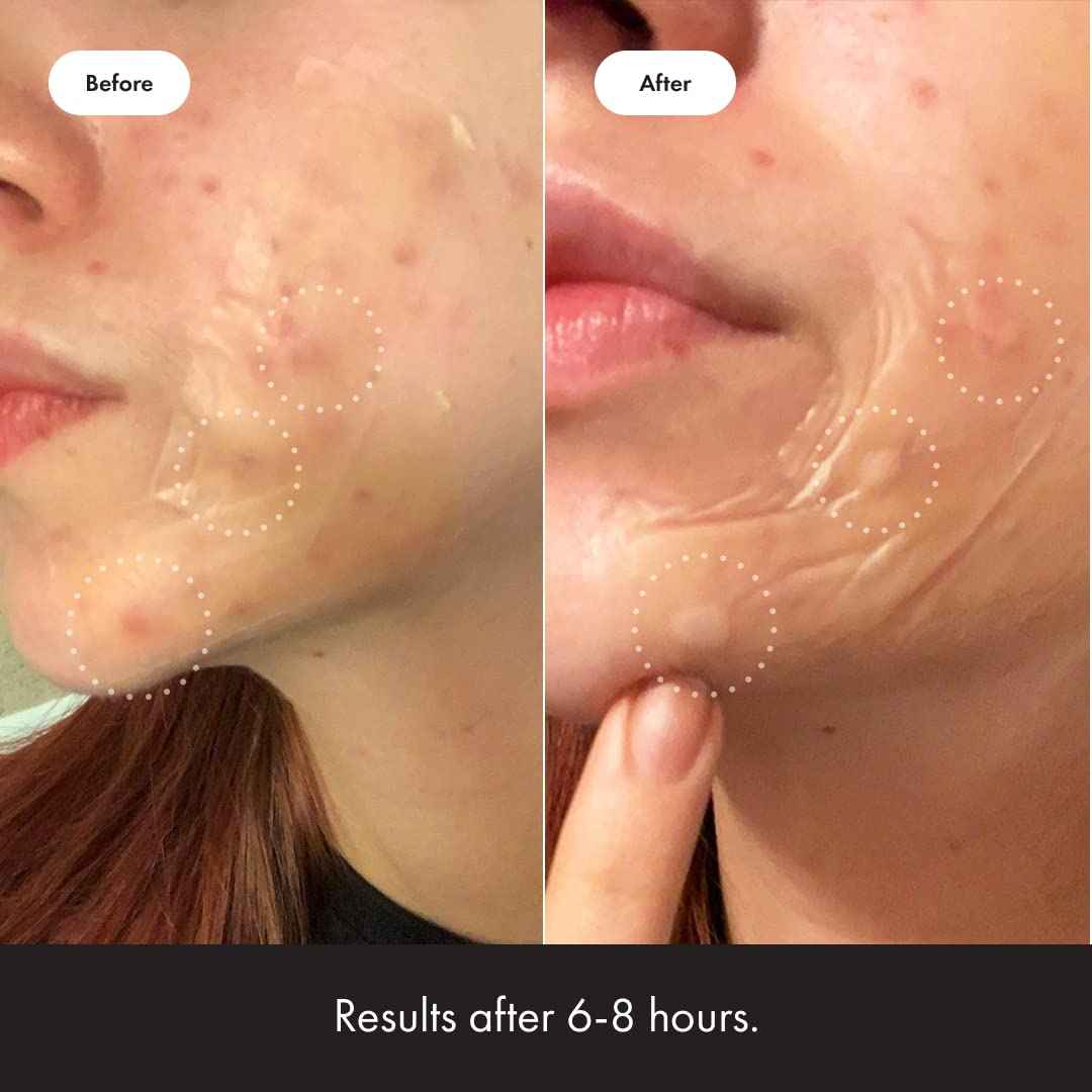 Mighty Patch Surface Large Pimple Patches for Face from Hero Cosmetics, Acne Spot for Body, Cheek, Forehead, and Chin, Pimple Stickers, Hydrocolloid Covers, Vegan-friendly, 10 Count