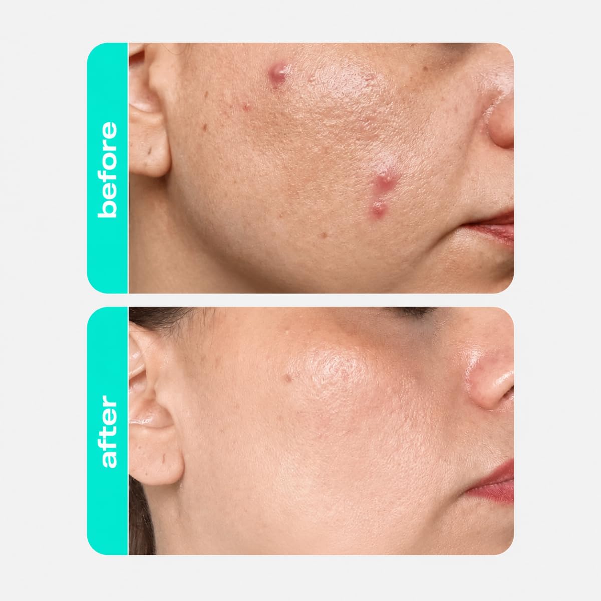 Creamy Salicylic Acid Toner | Anti-Acne Solution for Clear Skin | Effectively unclogs pores | Microbiota-Balancing Complex | Formulated for Sensitive Skin 3 Fl oz