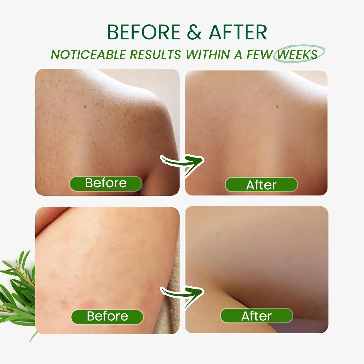 PHARMBANNER Tea Tree Antifungal Body Wash – Soothes Folliculitis, Acne, Jock Itch, Athlete’s Foot, Ringworm, Tinea Versicolor, Body Odor, Eczema & Dermatitis-Prone Skin