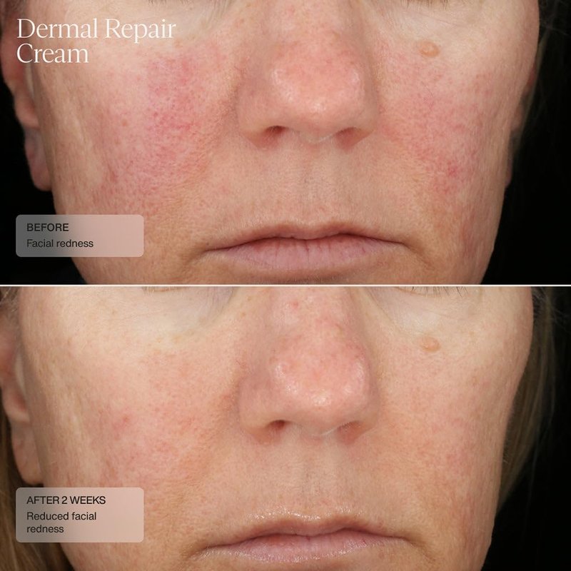 Senté Dermal Repair Facial Cream | Nourishing for Rosacea, Sensitive Skin, & Post-Procedure | Hydrate & Soothe| with Patented HSA, Vitamin E & Green Tea Extract | 1.7 Fl Oz