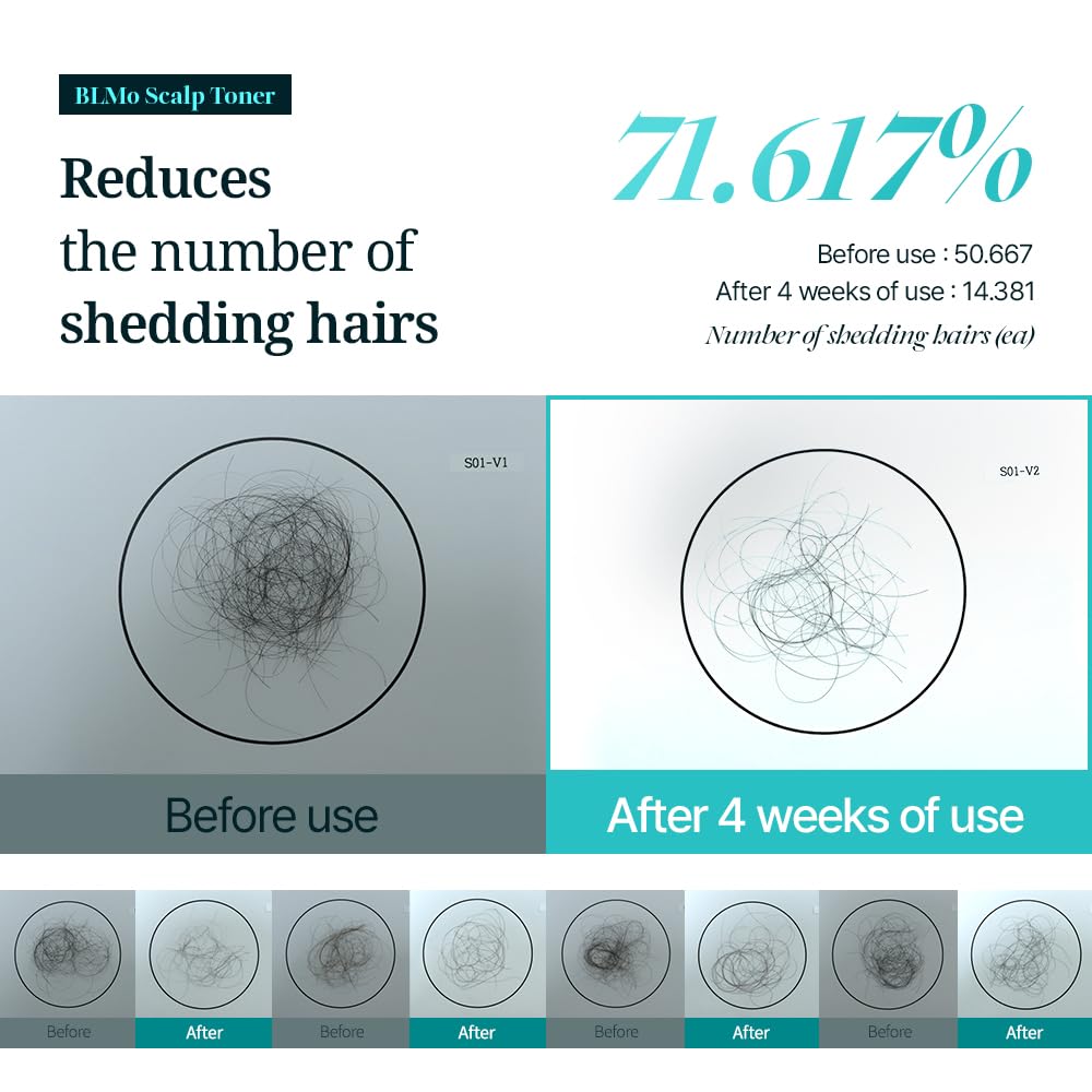 Scalp Serum for Hair Loss & Thinning with Massaging Tips | Clinically Proven | Thickens & Accelerates Hair Growth | Supports DHT Balance | Korean Hair Care | Low Irritation, Drug-Free | 4.05 fl.oz