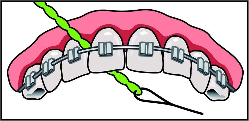 IDontix X-Floss Brace - Durable Green Support for Enhanced Performance