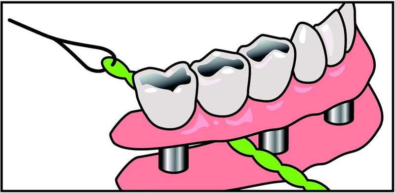 IDontix X-Floss Brace - Durable Green Support for Enhanced Performance