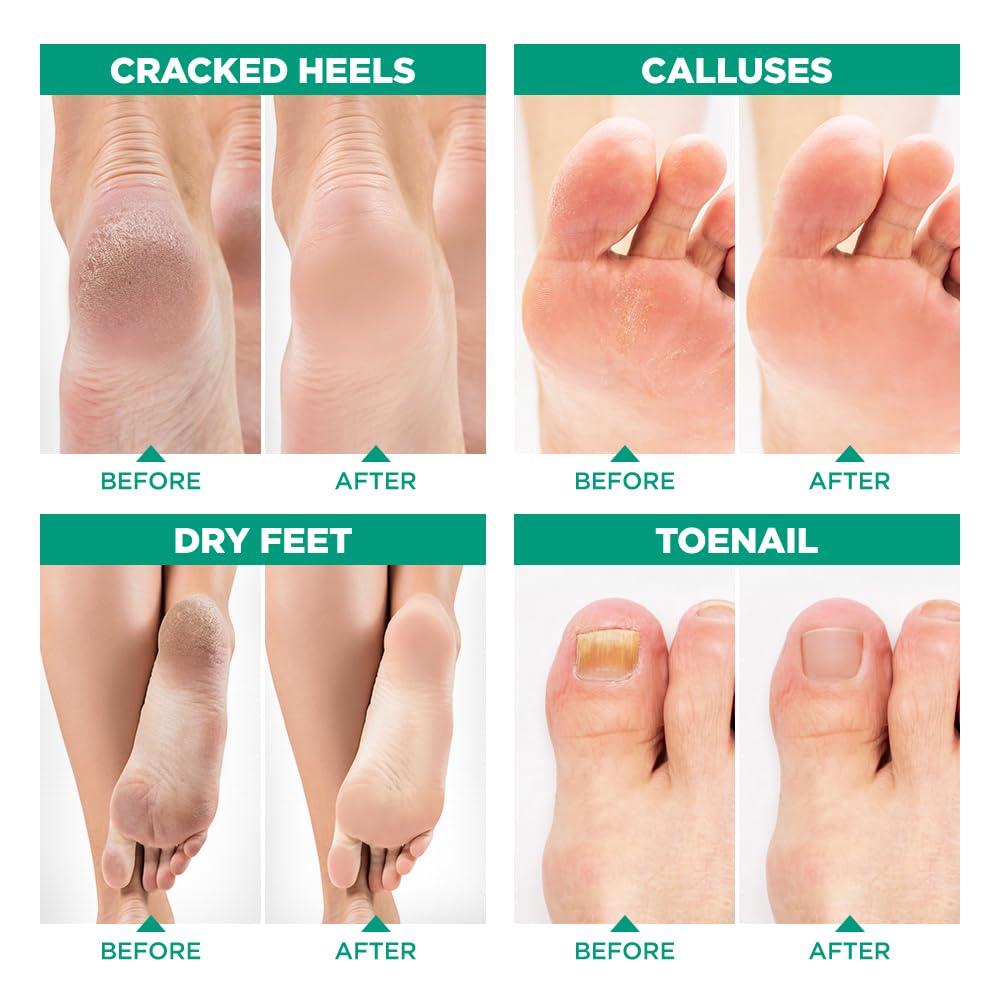 Lavinso Foot Peel Mask | Tea Tree Soak Care Kit for Dry, Cracked Feet - Removes Dead Skin & Calluses (1 lb)
