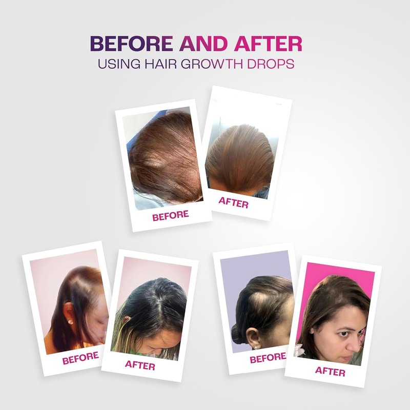 Capillary Hair Growth Drops - Natural Rosemary & Ginger Formula | 1.5% Minoxidil, Anti-Hair Loss Treatment, 4 Oz