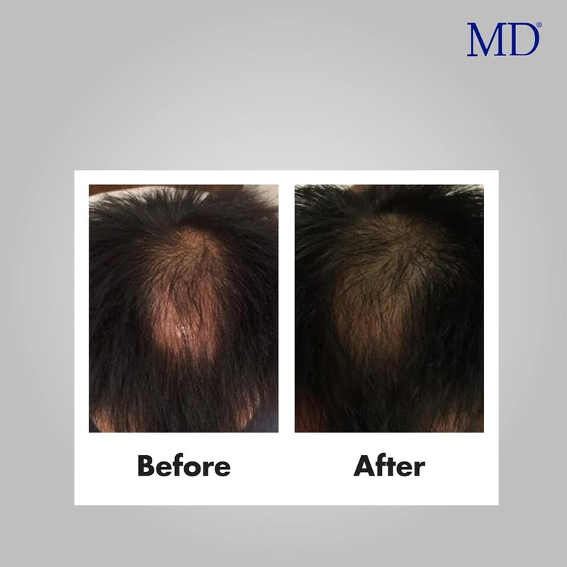 MD Scalp Essential Serum – Advanced Scalp Anti-Aging & Follicle Decongestant | Targeted 5-Alpha Reductase Support for Thinning Hair, Oil & Itch | Clinically Tested Non-Irritating Formula | 2 fl oz