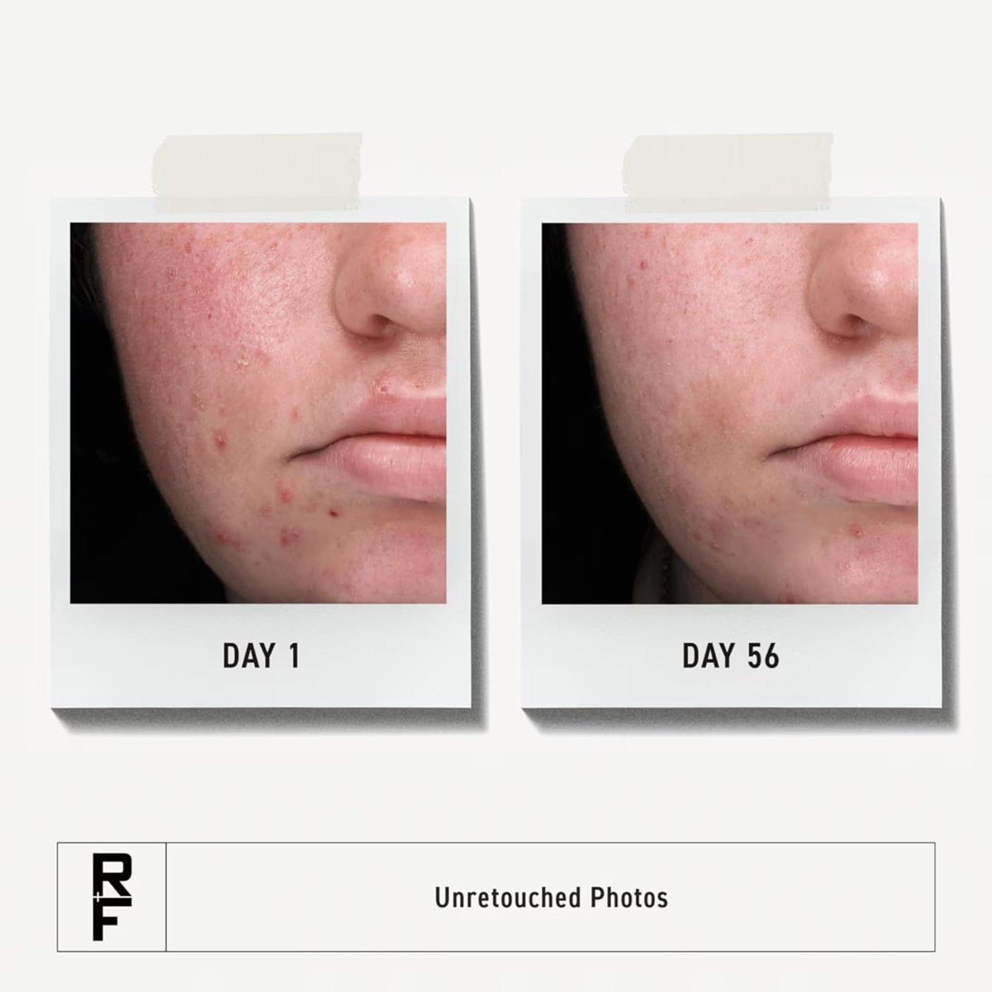 Rodan + Fields Spotless Regimen - Benzoyl Peroxide Face Wash for Sensitive Skin | Acne Treatment for Adults & Teens