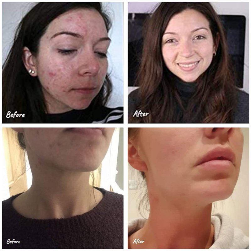 Science of Skin Rescue No. One - Blemish & Acne Scar Treatment Cream | Fast-Acting Formula