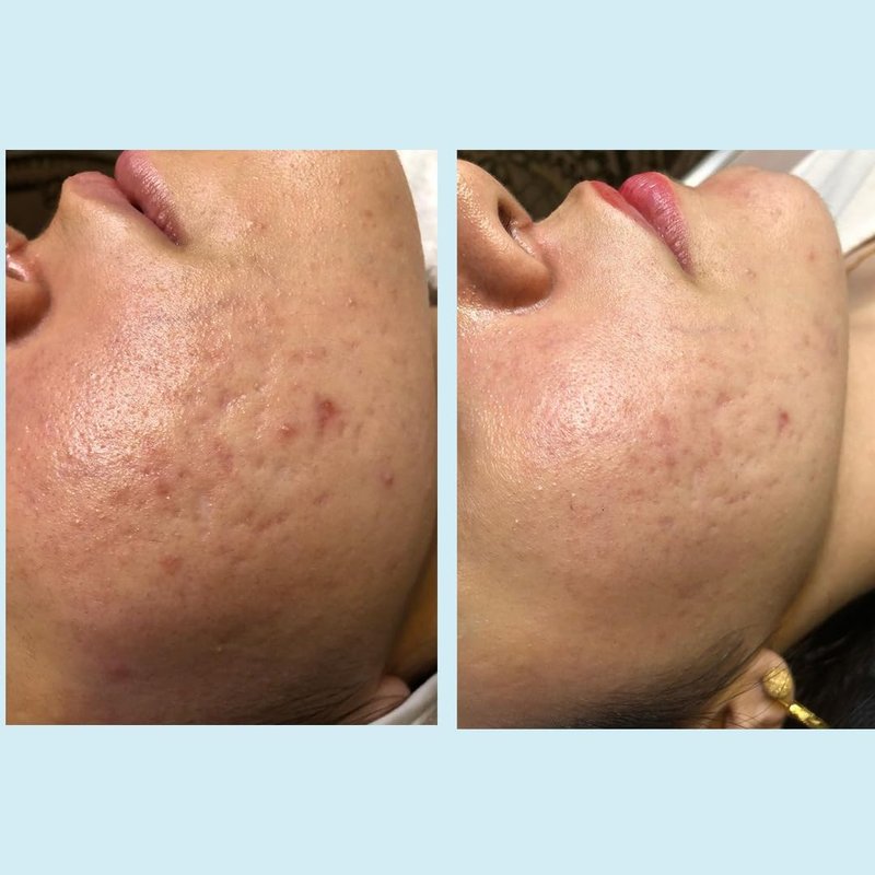 Salicylic 30% Gel Peel - Exfoliating Treatment with Tea Tree Oil & Green Tea Extract | 1 oz