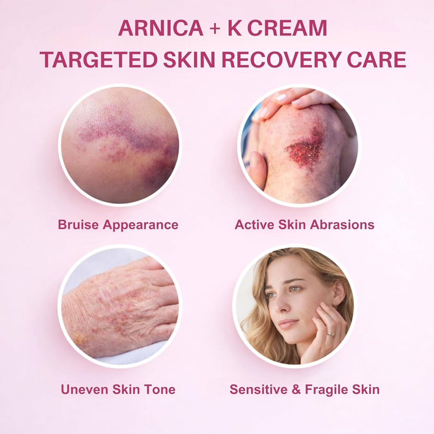Bruise Cream with Vitamin K– Moisturizing & Firming Formula for Arms, Legs & Hands -4.23 oz|Restores Fragile Skin with Anti-Wrinkle Benefits (Aloe Vera)