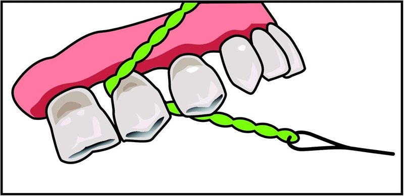 IDontix X-Floss Brace - Durable Green Support for Enhanced Performance