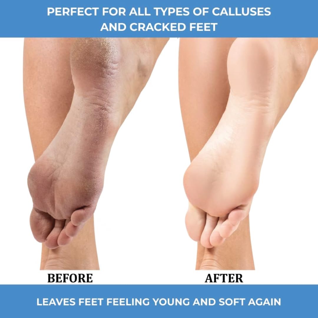 ForPro Advanced Callus Eliminator Gel, 8 oz. – Professional Grade, No Drip Callus Remover Gel for Feet