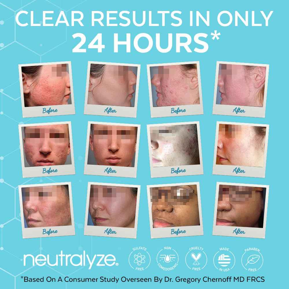 Neutralyze Moderate to Severe Acne Serum with 2% Mandelic Acid & 2% Salicylic Acid - Acne Scar & Spot Treatment for Face & Body (90 Day)