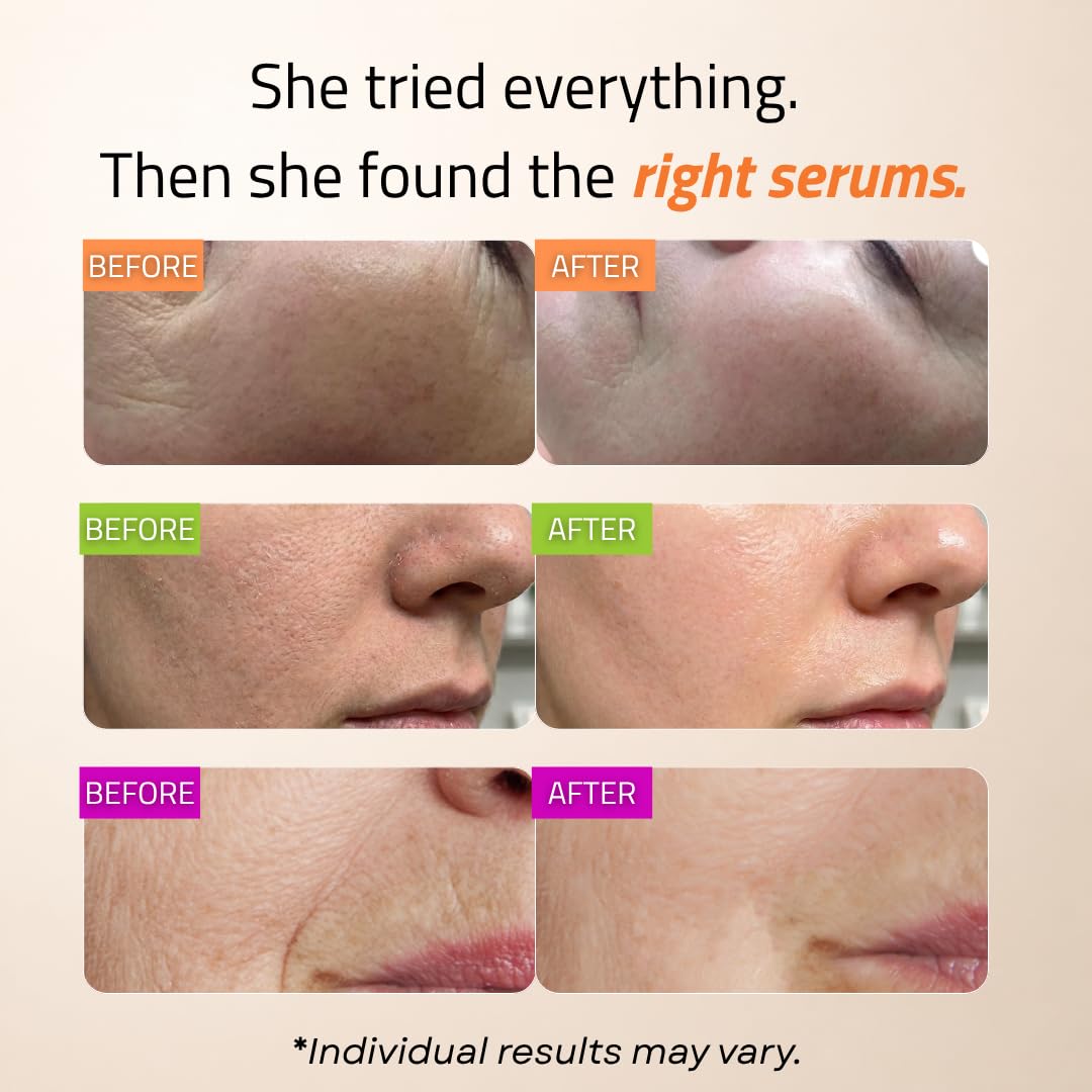 GLEOW Skincare Set: Retinol, Vitamin C, and 99% Hyaluronic Acid Serum, Face Serum Set Targets Appearance of Uneven Skin and Dryness, Total Package Serum Set 3x2 oz