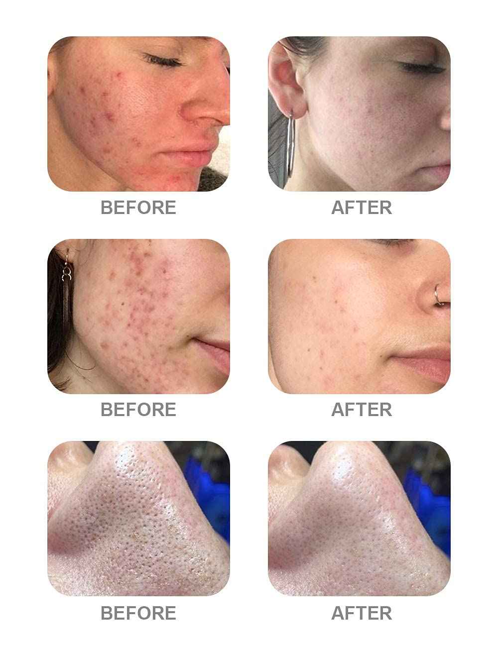 AS1 SA2 AO3 Aqua Peeling Solution Premium Salon Professional Dermabrasion Serum for Small Bubble Skin Care Facial Mask Machine (AS1 SA2 AO3, 3)