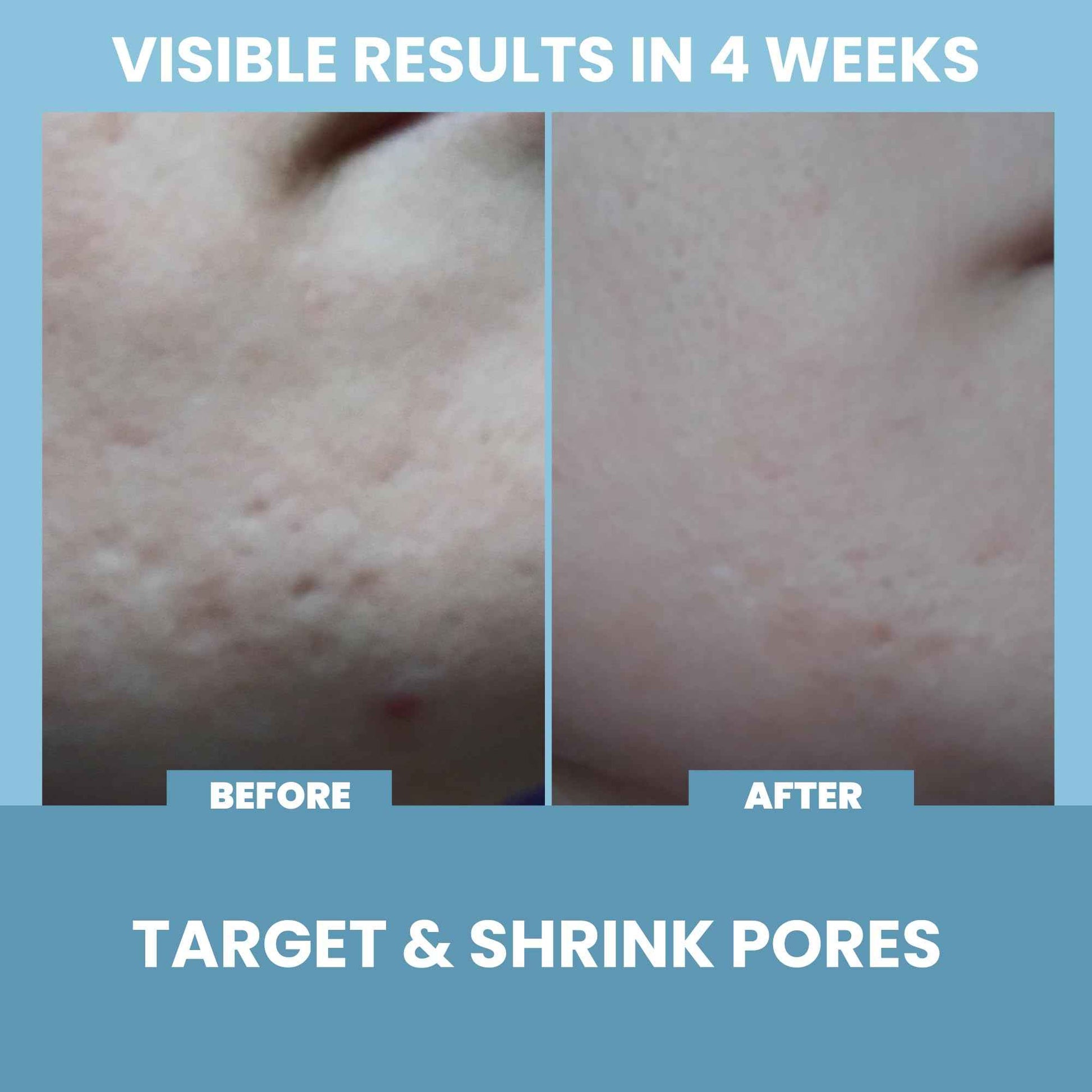 Eva Naturals Niacinamide 5% Serum for Face – B3 Pore Minimizer, Acne Treatment & Dark Spot Corrector with Hyaluronic Acid, Vitamin E, Aloe & Neem – Anti-Aging, Non-Greasy, Hydrating, 2oz