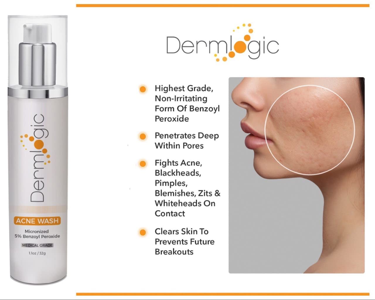 Dermlogic Acne Treatment- 5% Benzoyl Peroxide Face & Body Wash- Penetrates Deep within Pores to Immediately Fight Zits to Clear Skin. Eliminates and Prevents New Pimples from Forming.