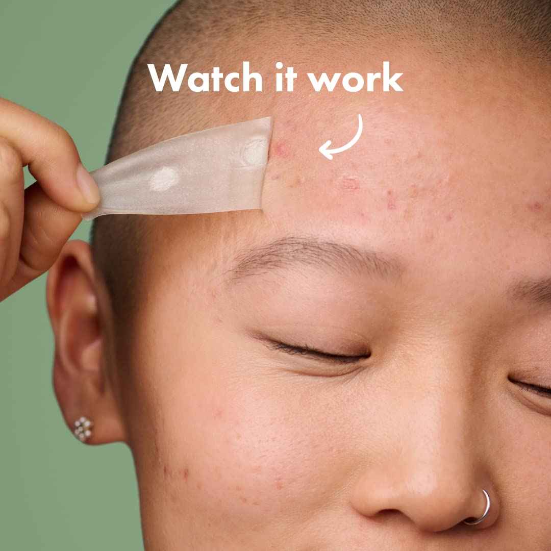 Mighty Patch Surface Large Pimple Patches for Face from Hero Cosmetics, Acne Spot for Body, Cheek, Forehead, and Chin, Pimple Stickers, Hydrocolloid Covers, Vegan-friendly, 10 Count