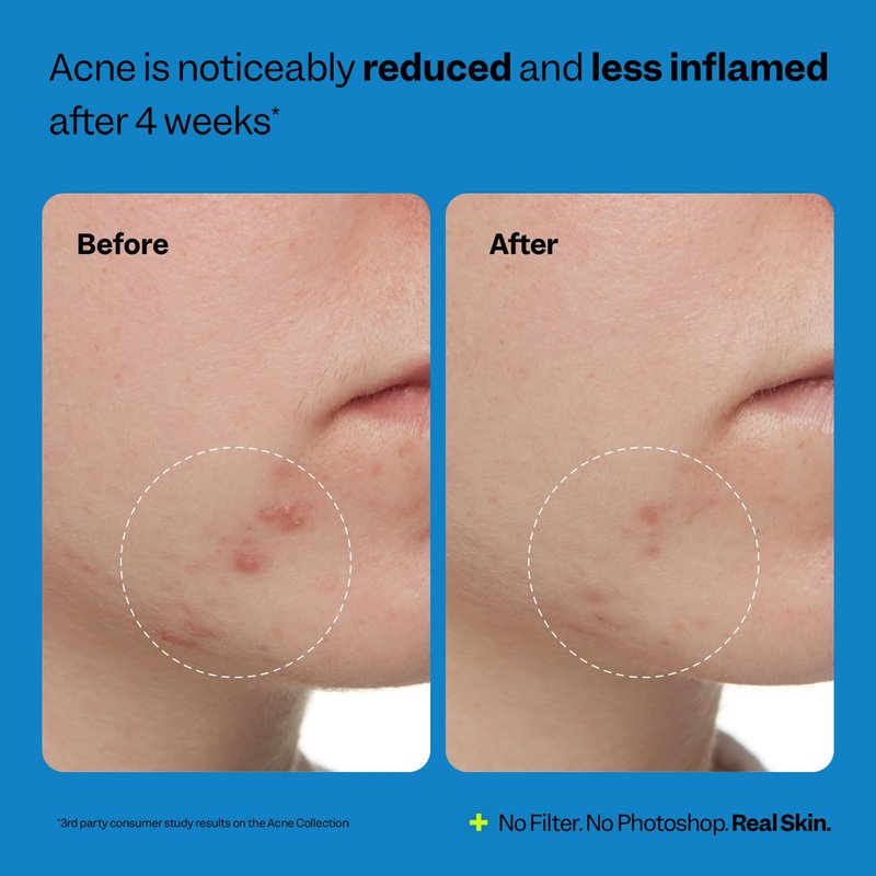 Peach Slices - Acne Exfoliating Toner (4.05 oz) - 2% Salicylic Acid Acne Treatment - Clear & Prevent Breakouts - Lactic & Glycolic Acid - Cucumber - Vegan, Cruelty Free, Korean Skin Care & Beauty