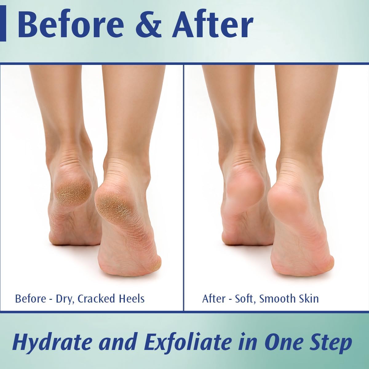 Pedifix 20% Urea Callus Control Foot Cream - Extra Strength Treatment for Dry, Cracked Feet | 4 Oz. (113g)