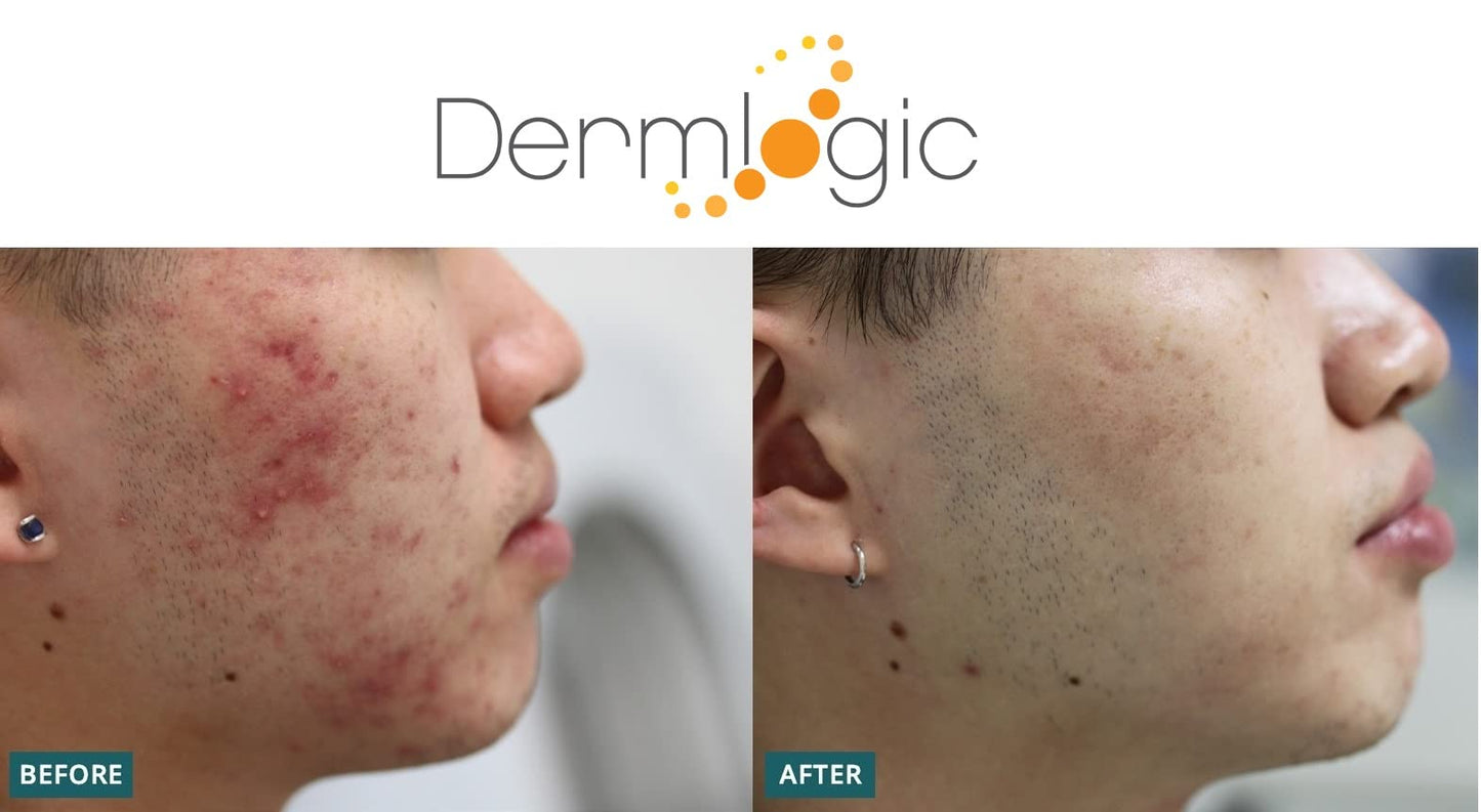 Dermlogic Acne Treatment- 5% Benzoyl Peroxide Face & Body Wash- Penetrates Deep within Pores to Immediately Fight Zits to Clear Skin. Eliminates and Prevents New Pimples from Forming.