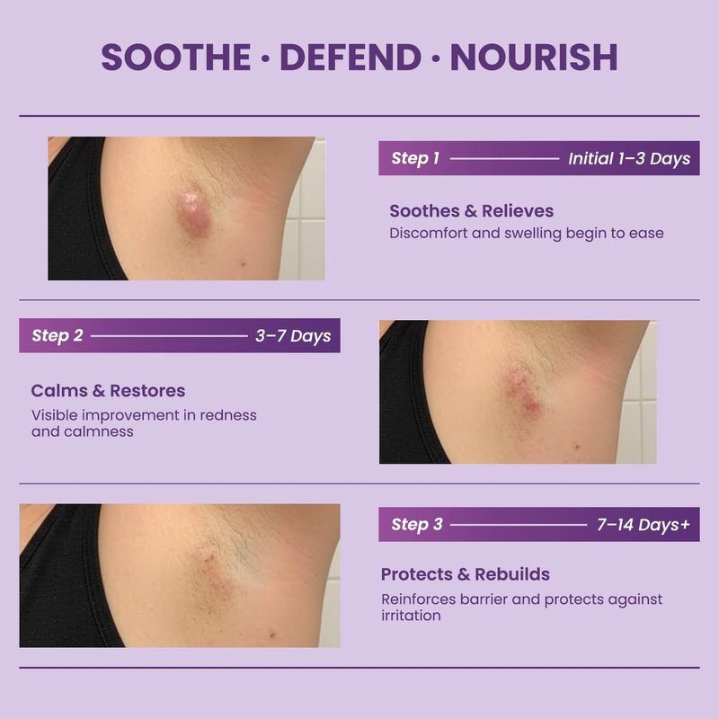 Easment Hidradenitis Suppurativa Flare Defense Balm: 2oz Science-Backed Daily Protection for Flare-Prone, Bump-Prone Skin – Microsilver BG™, Zinc Oxide & Botanical Blend – Non-Greasy, Non-Staining