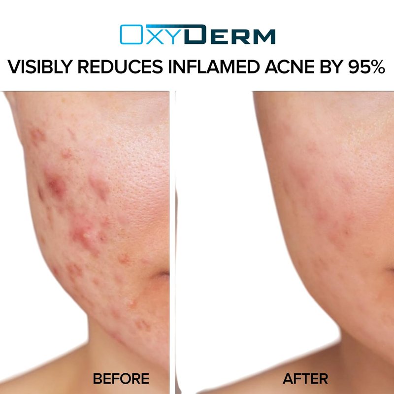 Acne Treatment Pads - Clear Clogged Pores & Fight Breakouts | 60 Count, Oily Skin Solution