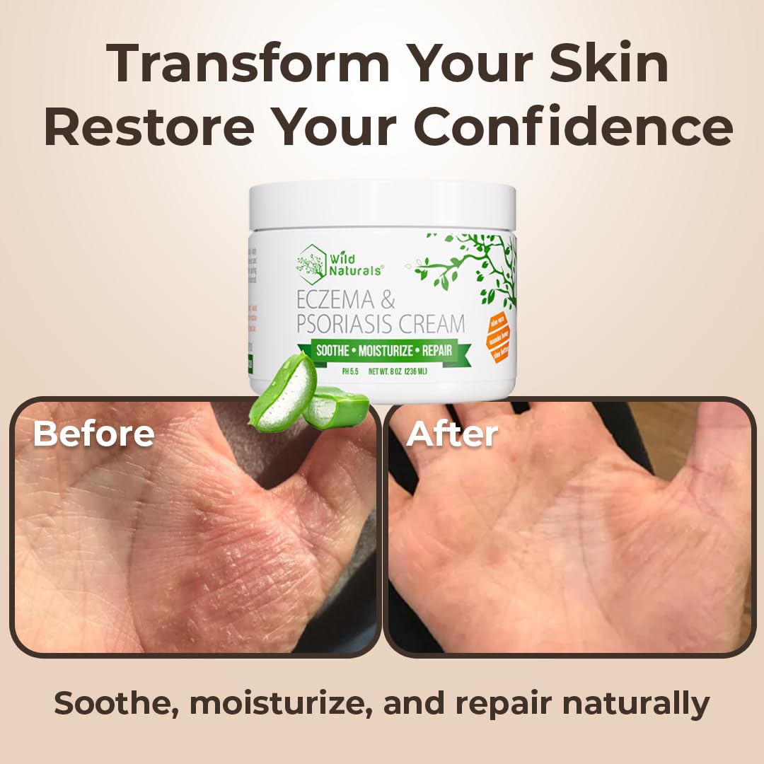 Wild Naturals Eczema & Psoriasis Cream for Dry, Itchy Skin – Eczema Relief for Adults & Kids – Moisturizing Psoriasis Cream with Manuka Honey