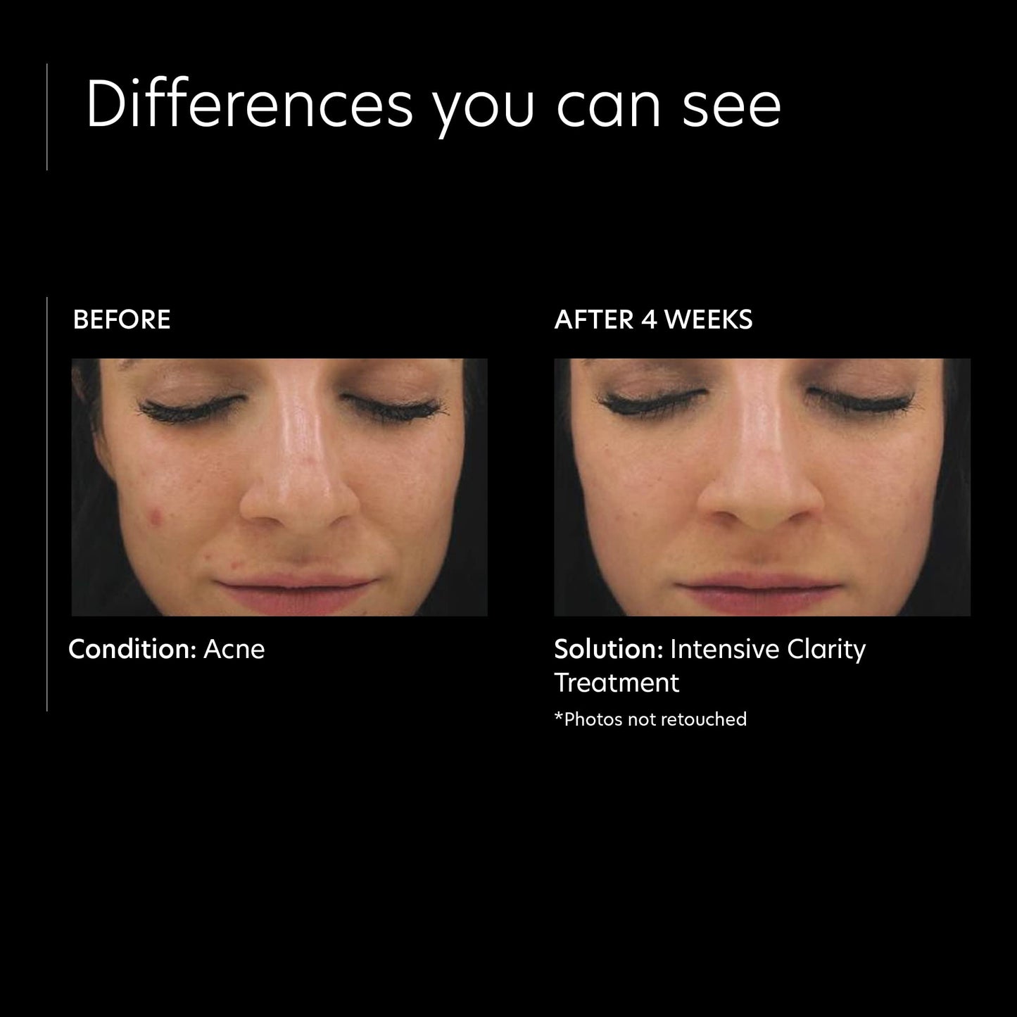 PCA SKIN Intensive Clarity Treatment - 0.5% Pure Vitamin A Retinol & 2% Salicylic Acid Face Serum for Acne-Prone Skin (1 oz)