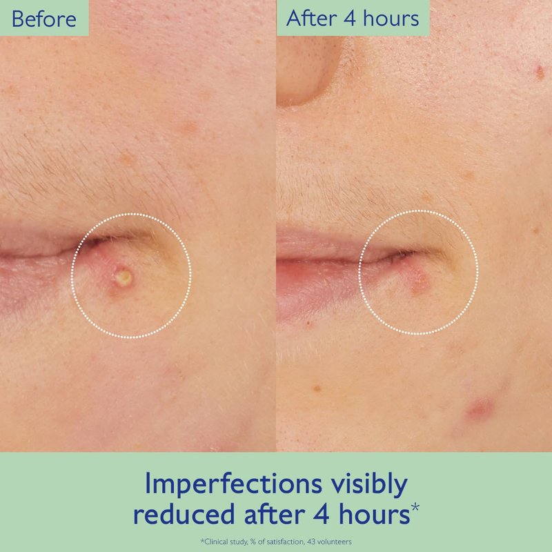 Vinopure Targeted Spot Solution with Salicylic Acid - 15 mL for Clear Skin