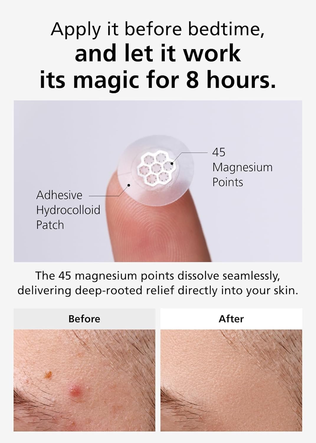 EasyDerm Micro Point Acne Patch Duo – 10 Magnesium Pimple Patches + 6 Real Calming Microdart Patches for Breakout & Post-Blemish Care, 2-Step K-Beauty Skincare Kit, Summer & Travel Essentials