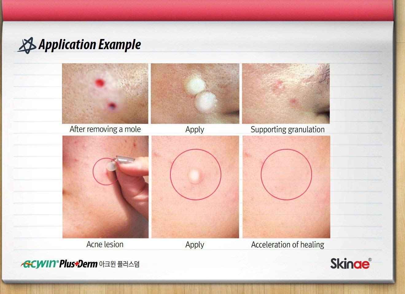 Acwin Plus Derm 4 Pack Acne Spot Pimple Absorbing Cover Patch, Moist Wound Dressing for Skin Trouble Acne Pimple Care Hydrocolloid Patch (Total 272 count)