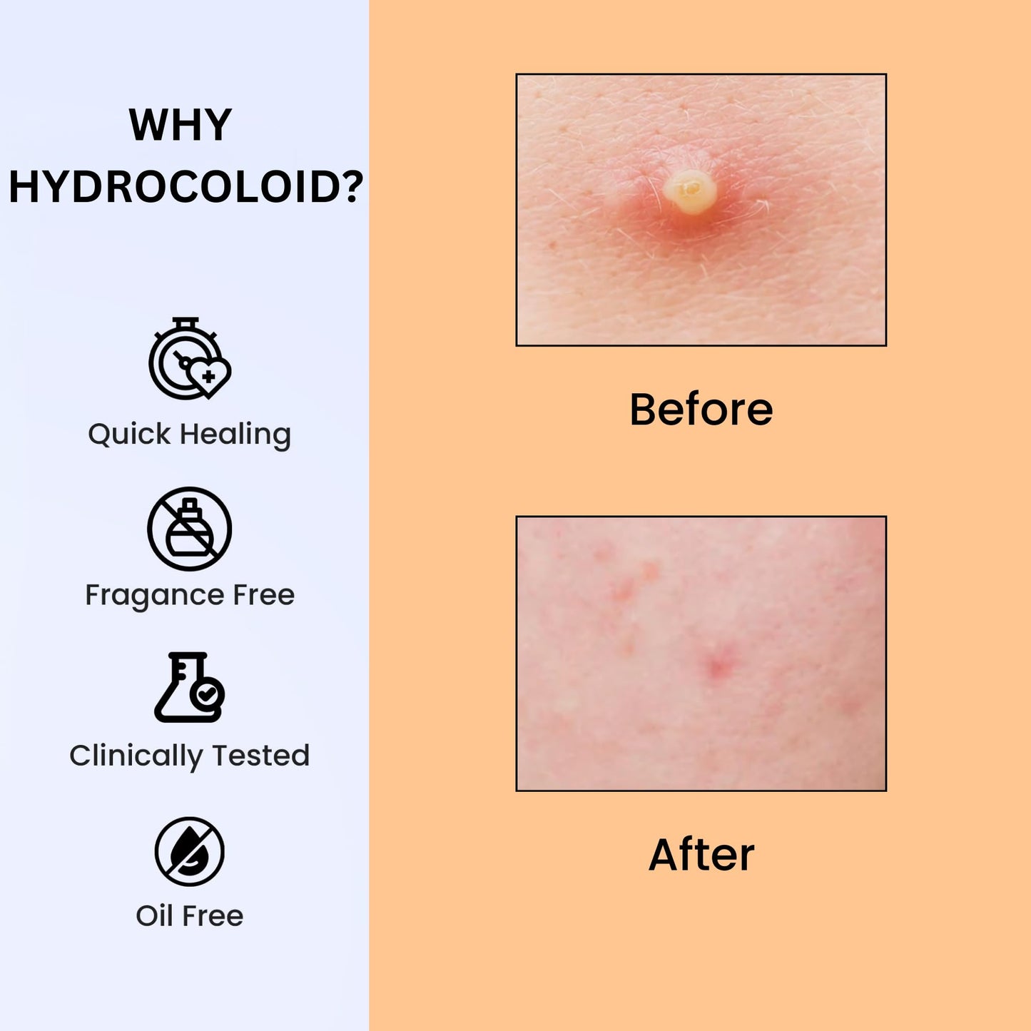 Sporty Acne Patches – Hydrocolloid Spot Cover for Zits, Pimples & Blemishes, Fast-Acting Formula, Long-Lasting & Gentle on Skin. (36 Count)