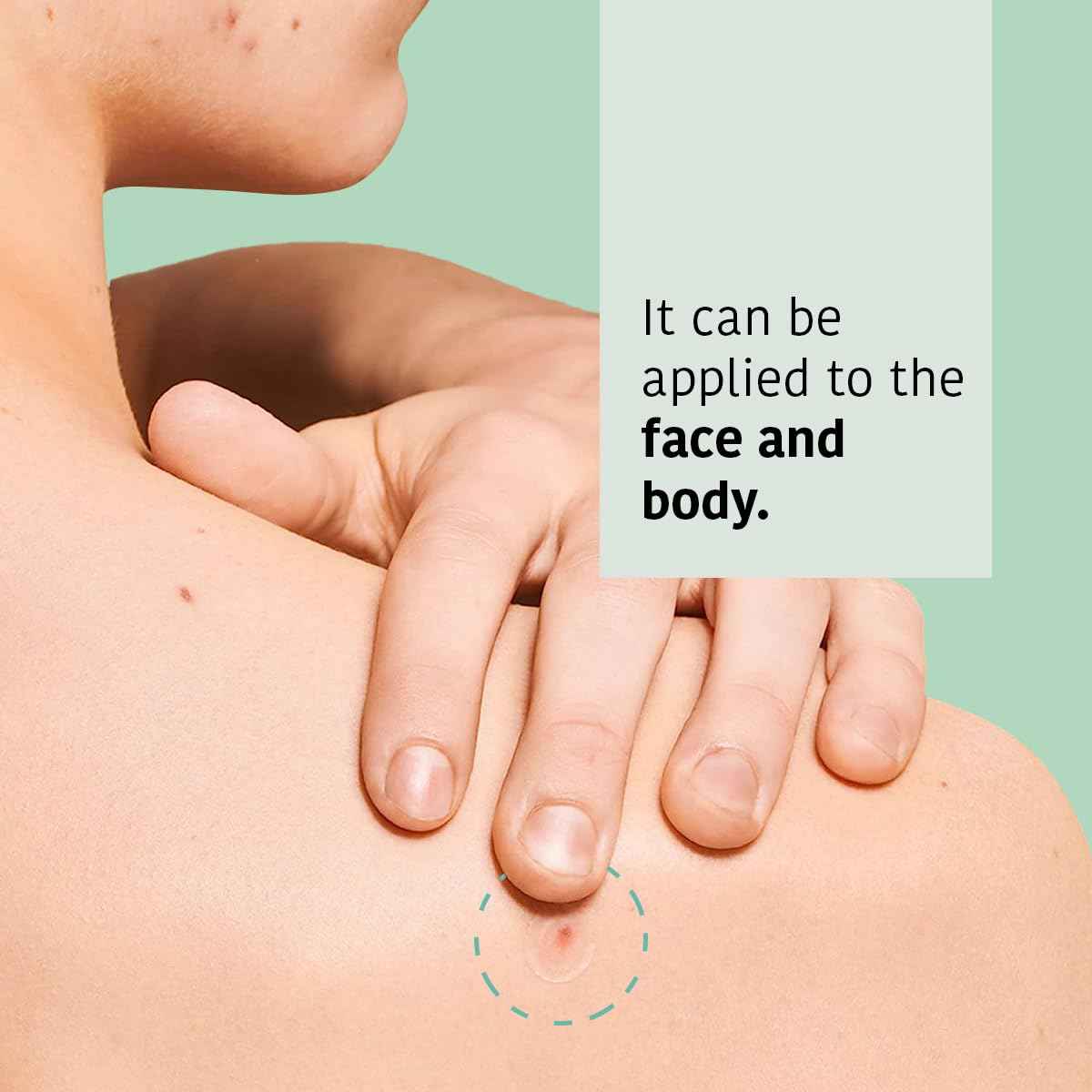 IROHA NATURE Hydrocolloid Pimple Patches with Salicylic Acid (90 Count - Pack of 5), Tea Tree & Centella Asiatica | Reduces Pimples Quickly and Effectively in 8h | Acne Patches