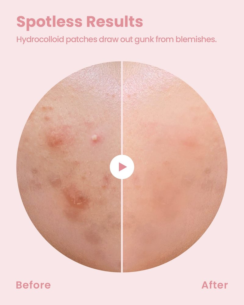 GLAM UP Hydrocolloid Blemish Pimple Zit Patches(180PCS/2Size) - Invisible Ultra Thin Spot Cover Stickers for Face and Skin, Strong Water-proof and Adhesive Overnight, Vegan-friendly