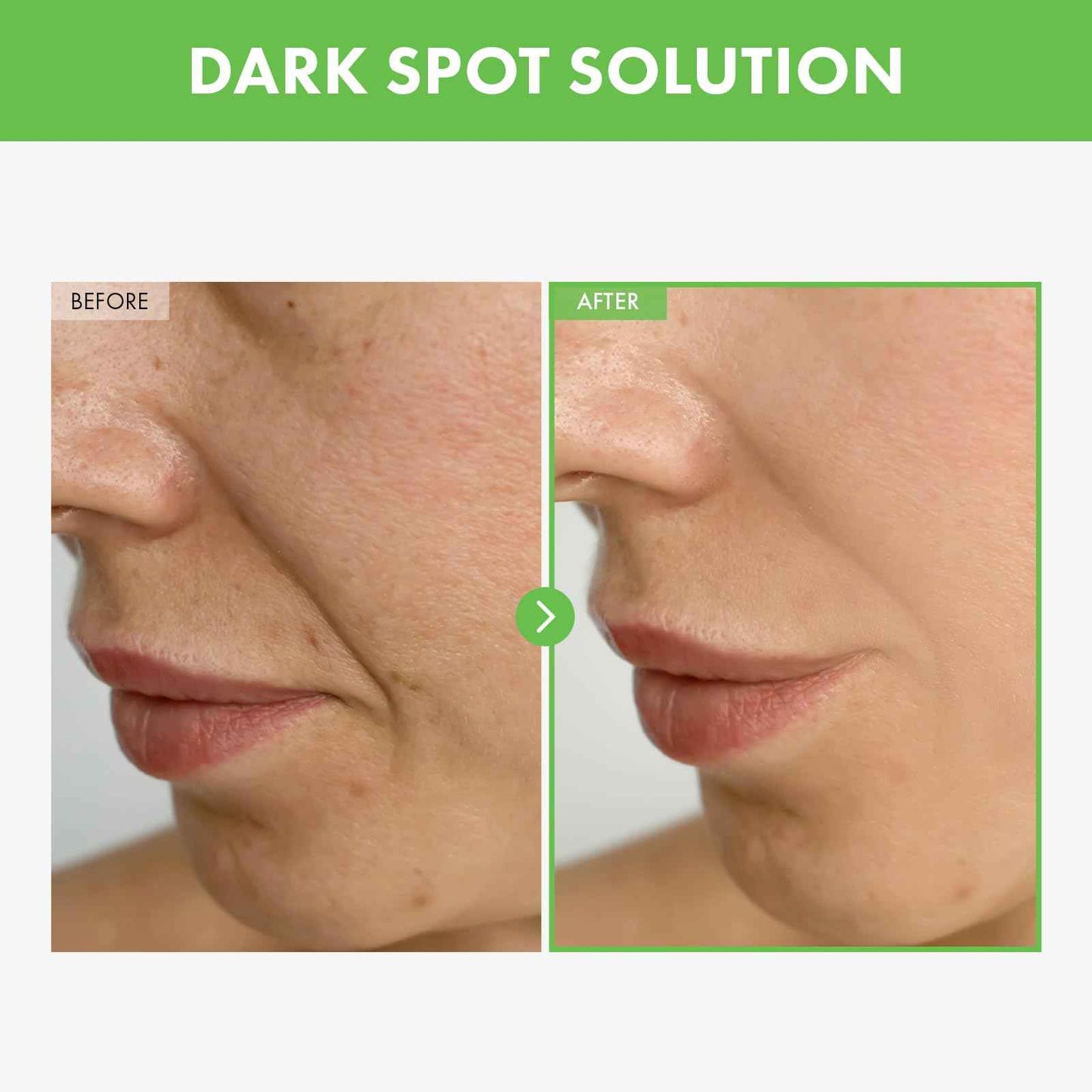 TOSOWOONG Kakadu Plum Blemish Cream, Dark Spot Remover for Face Cream, Kakadu Plum 600,000ppm, Niacinamide, Adenosine, Betaine, Dark Spot Corrector, Vitamin C, Korean Skin Care, 50g, 1.76 oz.