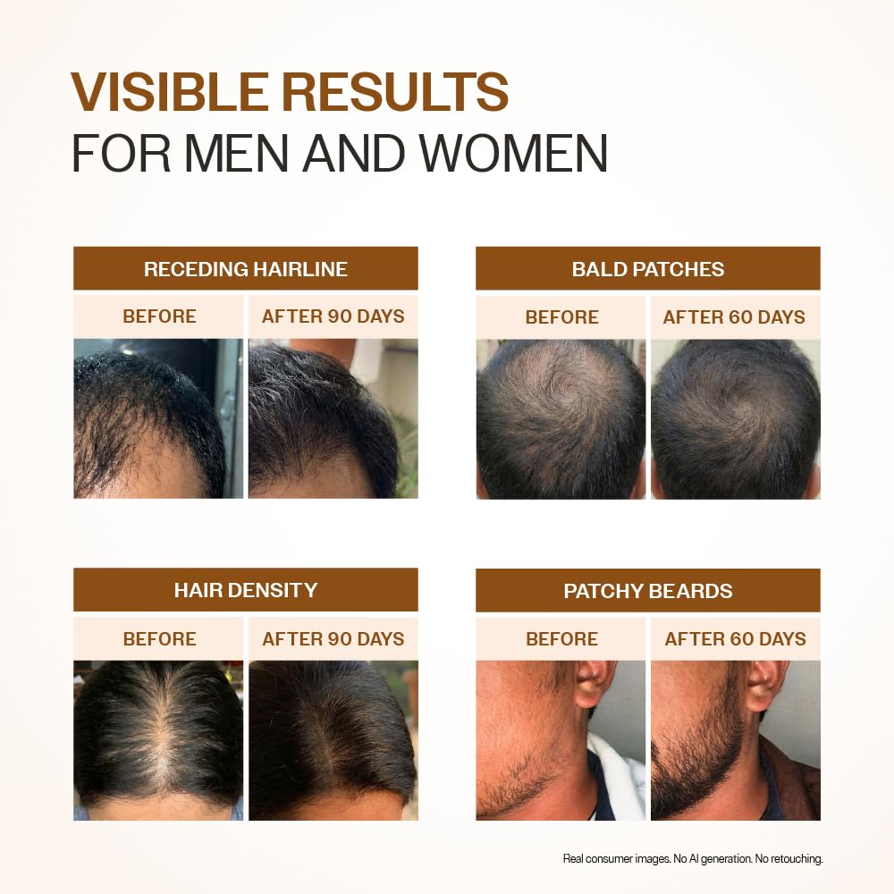 Bare Anatomy Advanced Hair Growth Serum| 3% Redensyl - 2x Better Results than Minoxidil | + 4% Anagain + 3% Baicapil | Rosemary, Biotin | Hair growth & Hair fall control serum for Women & Men | 30mL