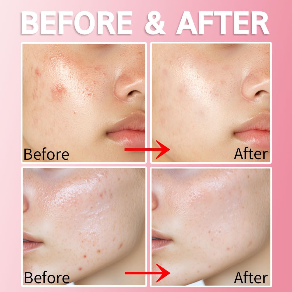 Purederm Salicylic Acid Acne Spot Treatment for Face, 0.67 fl.oz.