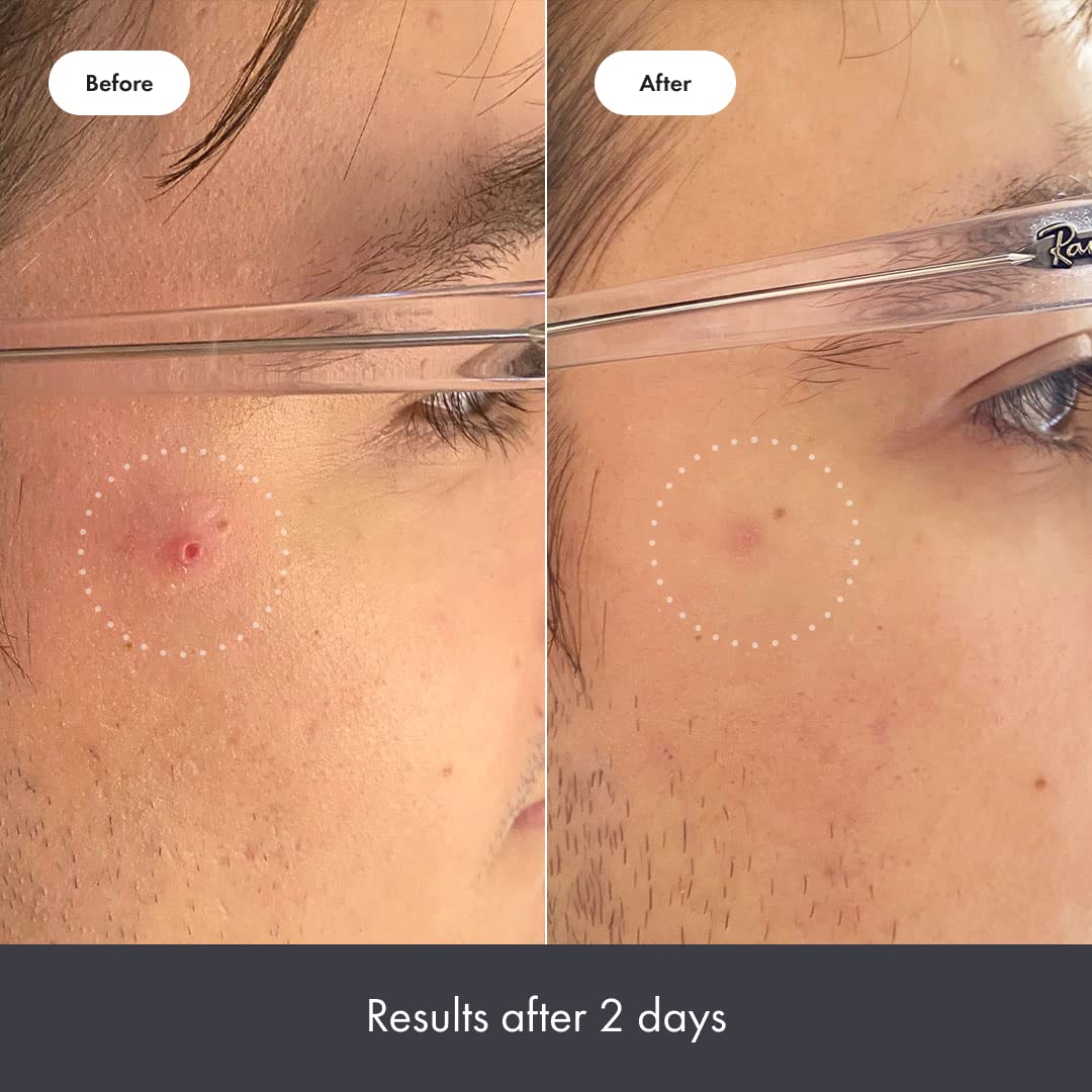 Hero Cosmetics Rescue Balm Post-Blemish Recovery Cream - Intensive Nourishing and Calming for Dry, Red-Looking Skin - Dermatologist Tested (15 ml, 0.5 fl. oz)