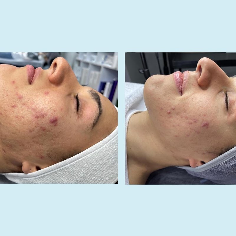 Salicylic 30% Gel Peel - Exfoliating Treatment with Tea Tree Oil & Green Tea Extract | 1 oz