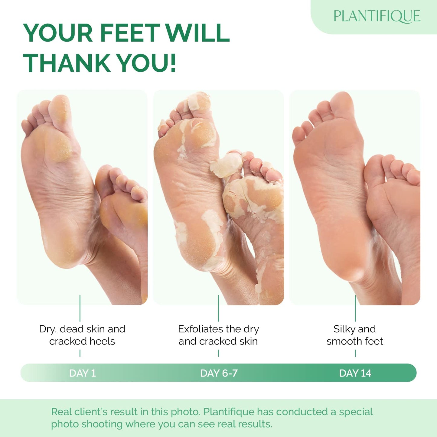 Foot Peeling Mask - Hydrating Treatment for Dry & Cracked Feet | 4 Pack