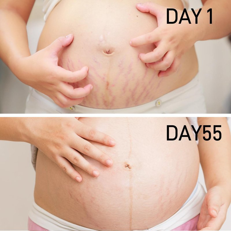 PEGO Stretch Mark Oil for Pregnancy, Maternity Body Oil for Stretch Mark Prevention & Reduction, Hydrating Skin Care, 5.41oz (Oil+Cream)