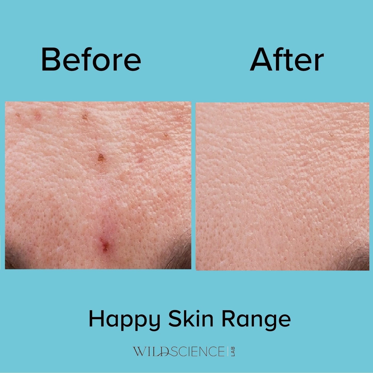 Wild Scicen Lab HAPPY BALANCE AHA + BHA + Zinc Clarifying Essence for Acne-Prone Skin